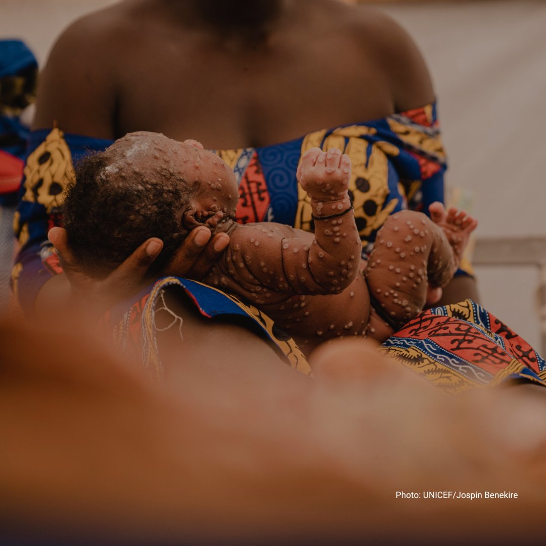 RDC : Plus de 200 cas suspects de Mpox signalés à Moba, province du Tanganyika